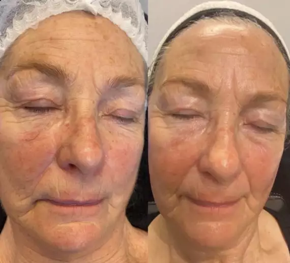hydrafacial3 -  - HydraFacial