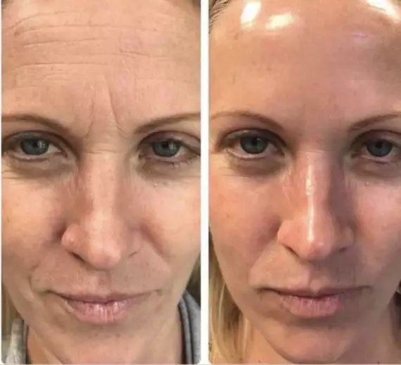 hydrafacial4 -  - HydraFacial
