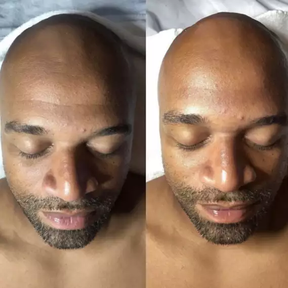 hydrafacial5 -  - HydraFacial