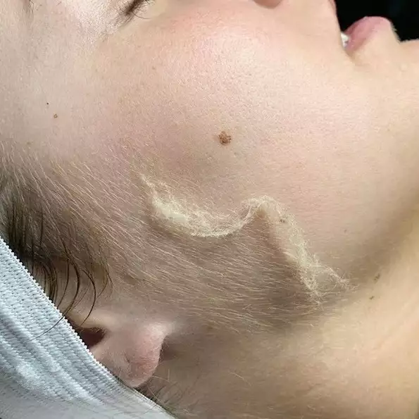 dermaplaning2 -  - dermaplaning