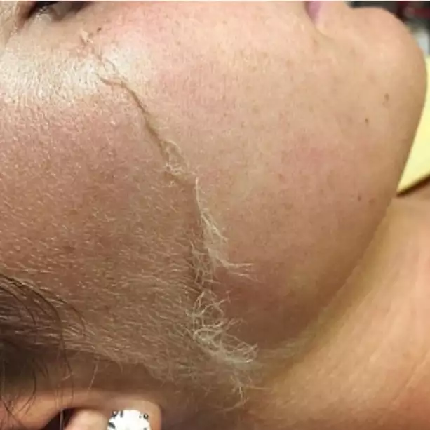 dermaplaning1 -  - dermaplaning